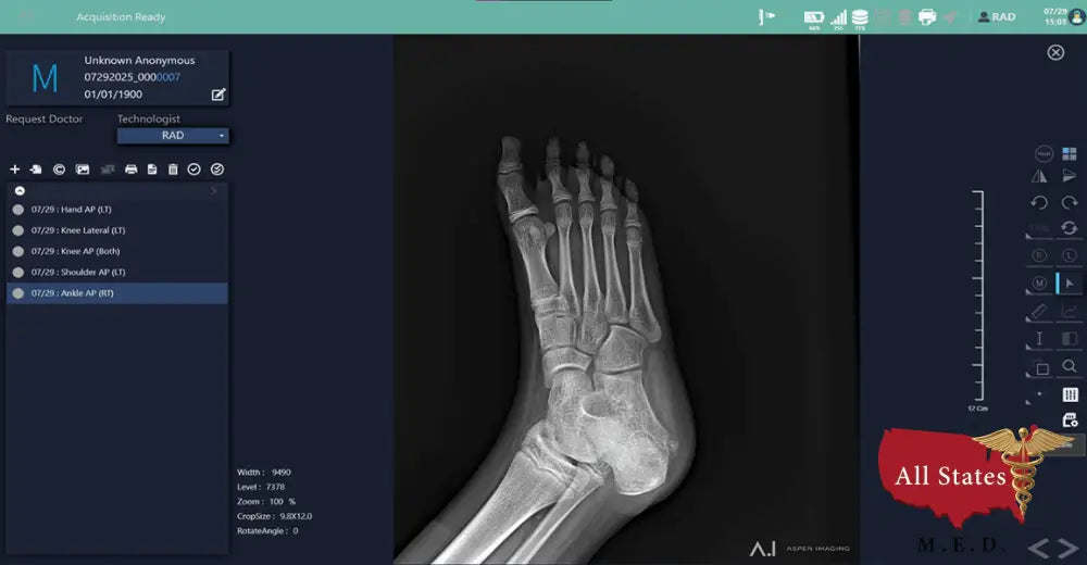 Hand Held Digital X-ray Europa 85