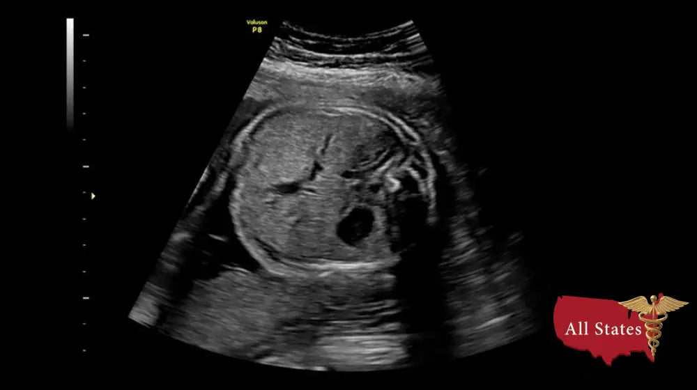 GE VOLUSON P8 BT22 Brand New